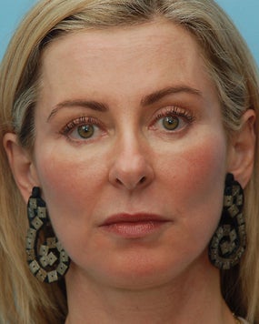 Cheek Augmentation Using Juvederm after 658794