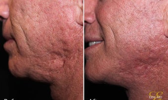 Laser Resurfacing before 342197
