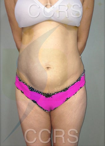 35 yr. old female for body contouring before 636292
