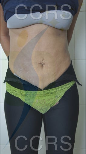 35 yr. old female for body contouring after 636292