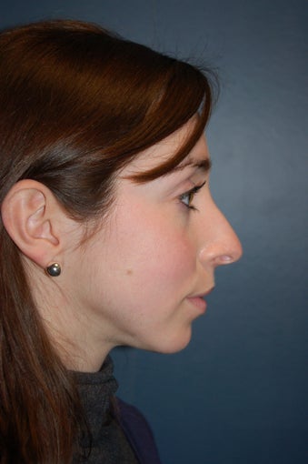 Nose Surgery before 928639