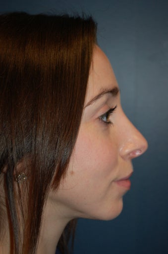 Nose Surgery after 928639