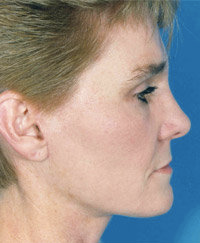 Facelift after 507835
