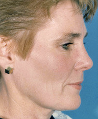 Facelift 507835