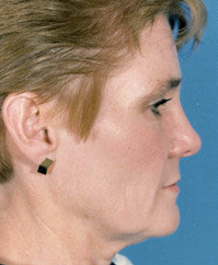 Facelift before 507835