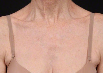 Fraxel Dual for Sun Damage after 539847