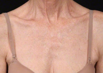Fraxel Dual for Sun Damage before 539847