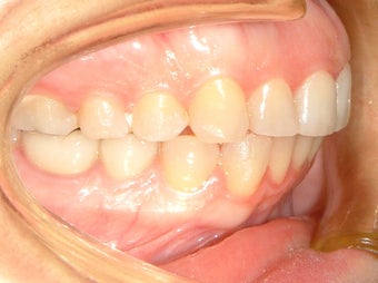 overbite after 893153
