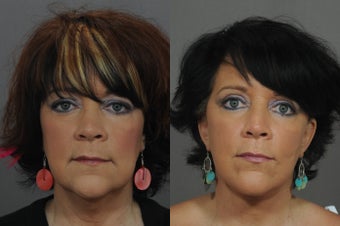Facelift and Neck Lift before 850312