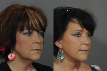 Facelift and Neck Lift after 850312
