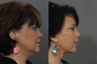Facelift and Neck Lift 850312