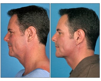 Neck Lift before 331119