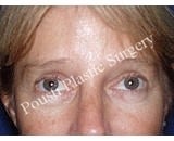 Forehead Lift after 921876