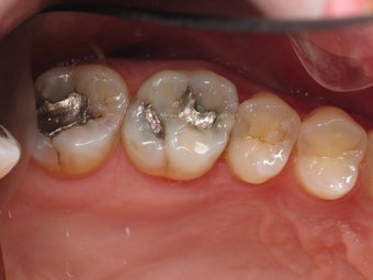 Mercury Silver filling replacment before 372787