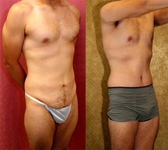 tummy tuck before 232462