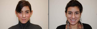 Ear surgery (Otoplasty) before 96778