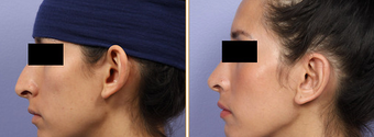 Ear Surgery before 272317