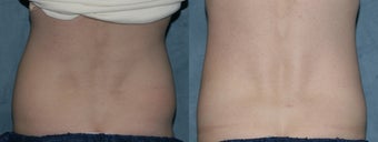 Zeltiq for fat reduction on "muffin top" / flanks before 183874