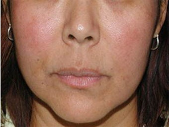 Cosmelan for Melasma after 113208