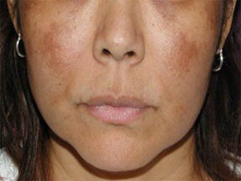 Cosmelan for Melasma before 113208