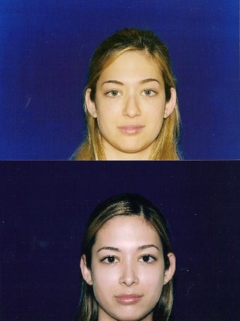 Rhinoplasty before 229773