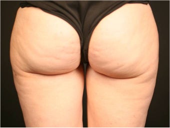 SmartLipo MPX after 686143