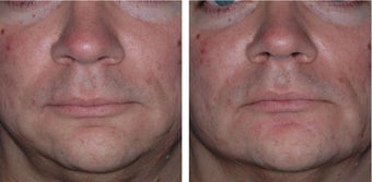 35 Year Old Male Treated for Jawline Contouring before 1367252