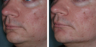 35 Year Old Male Treated for Jawline Contouring after 1367252