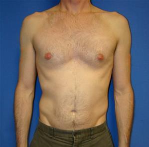 Pectoral Augmentation Surgery before 110900