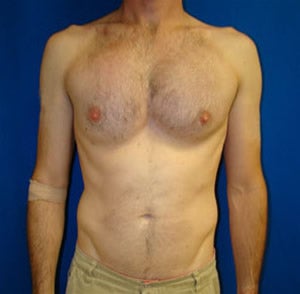 Pectoral Augmentation Surgery after 110900