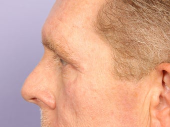 Eyelid Surgery after 280851