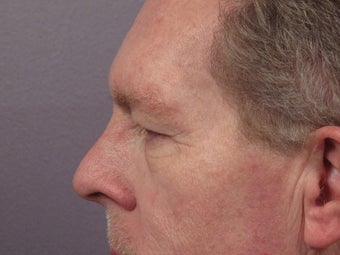 Eyelid Surgery before 280851