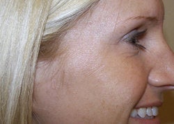Botox to the Crow's Foot Area after 85858