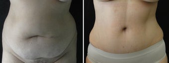 Belly Button Surgery after Tummy Tuck before 1192802