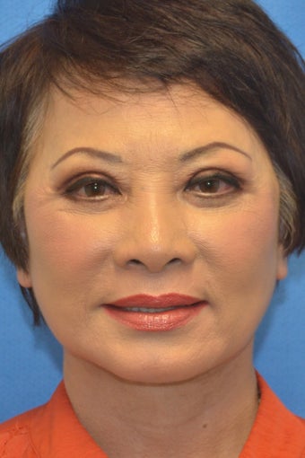 Asian Female Treated with Buccal Fat Removal after 994338