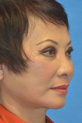 Asian Female Treated with Buccal Fat Removal 994338