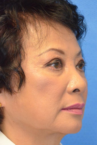 Asian Female Treated with Buccal Fat Removal 994338