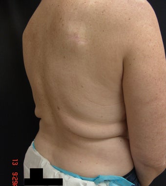 Coolsculpting before 423629