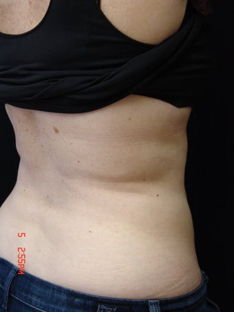 Coolsculpting after 423629