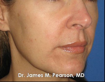 Melasma Treatment after 910410