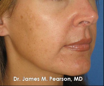 Melasma Treatment before 910410