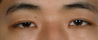 Asian Blepharoplasty after 857912