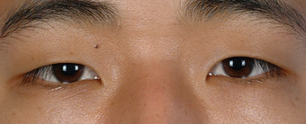 Asian Blepharoplasty before 857912