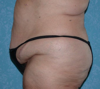 Circumferential Body Lift with Liposuction to Upper/Outer Abdomen 857738