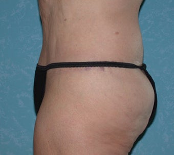 Circumferential Body Lift with Liposuction to Upper/Outer Abdomen 857738