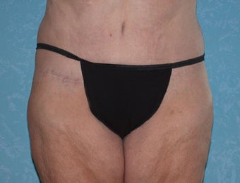 Circumferential Body Lift with Liposuction to Upper/Outer Abdomen after 857738