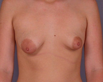 Breast Asymmetry Correction before 281328
