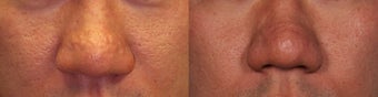 Sebaceous Hyperplasia Acne Scars Before and After before 1039837