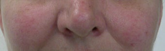 50 year old Female Treated for Rosacea and Facial Veins after 694715