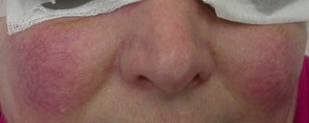 50 year old Female Treated for Rosacea and Facial Veins before 694715